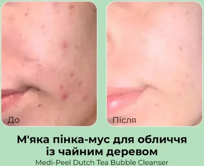 Пінка-мус Medi-peel Dutch Tea з чайним деревом 160 млфото