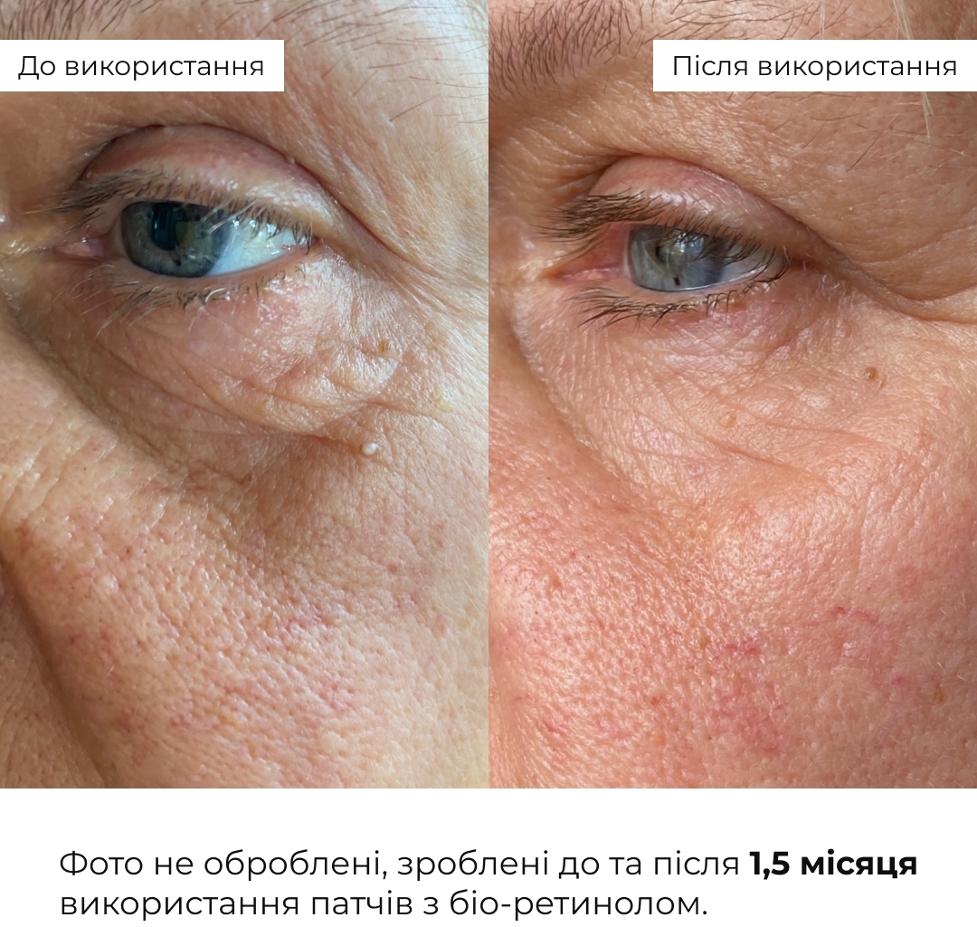 Патчі розгладжувальні Hillary Bacuchiol Wrinkle Correcting &amp; Eye Lift Patche з біо-ретинолом 60 штфото