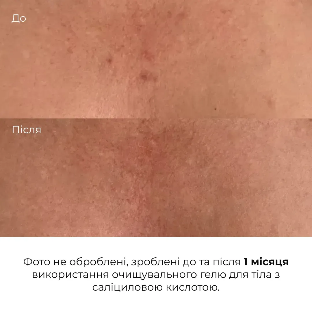 Гель для тіла очищувальний Hillary Anti-Acne Salicylic Body Wash з саліциловою кислотою 200 млфото