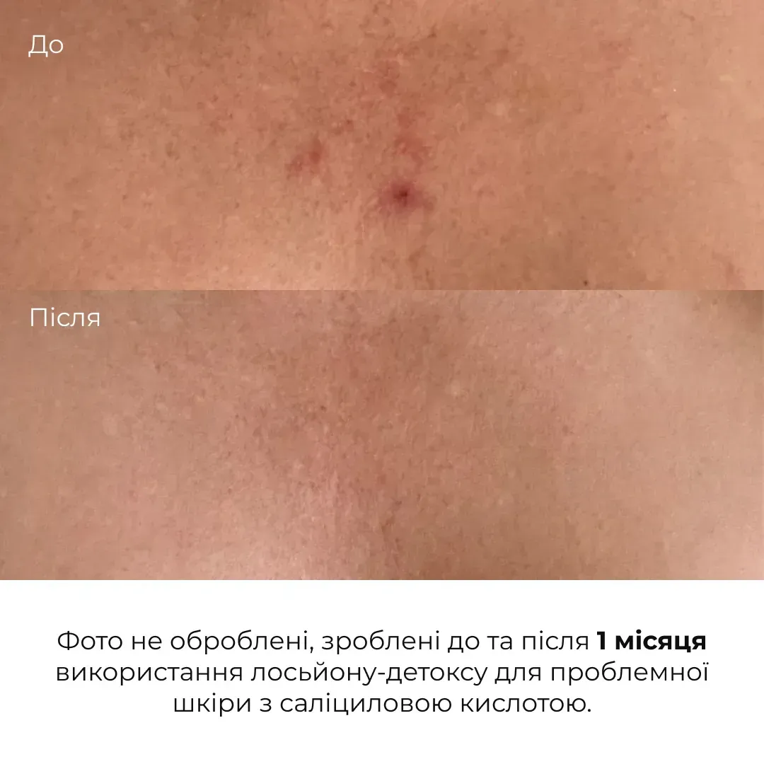 Лосьон-детокс для проблемной кожи Hillary Anti-Acne Salicylic Body Lotion с салициловой кислотой 150 мл фото 4