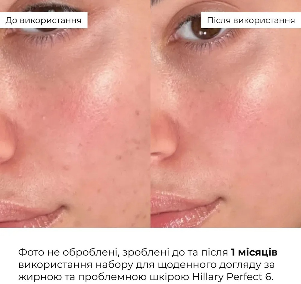 Набор Hillary Perfect 6 для ежедневного ухода за жирной и проблемной кожей фото 11