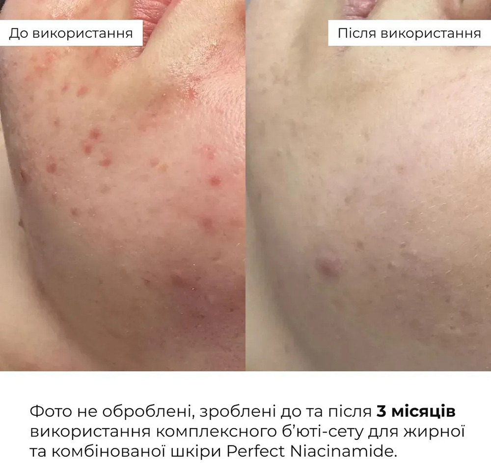 Комплексний б'юті-сет Hillary Perfect Niacinamide Sebo Balance для жирної та комбінованої шкірифото