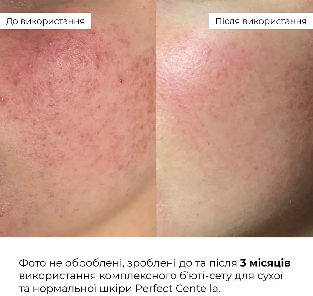 Комплексный бьюти-сет Hillary Perfect Centella Deep Hydration для сухой и нормальной кожи фото 9