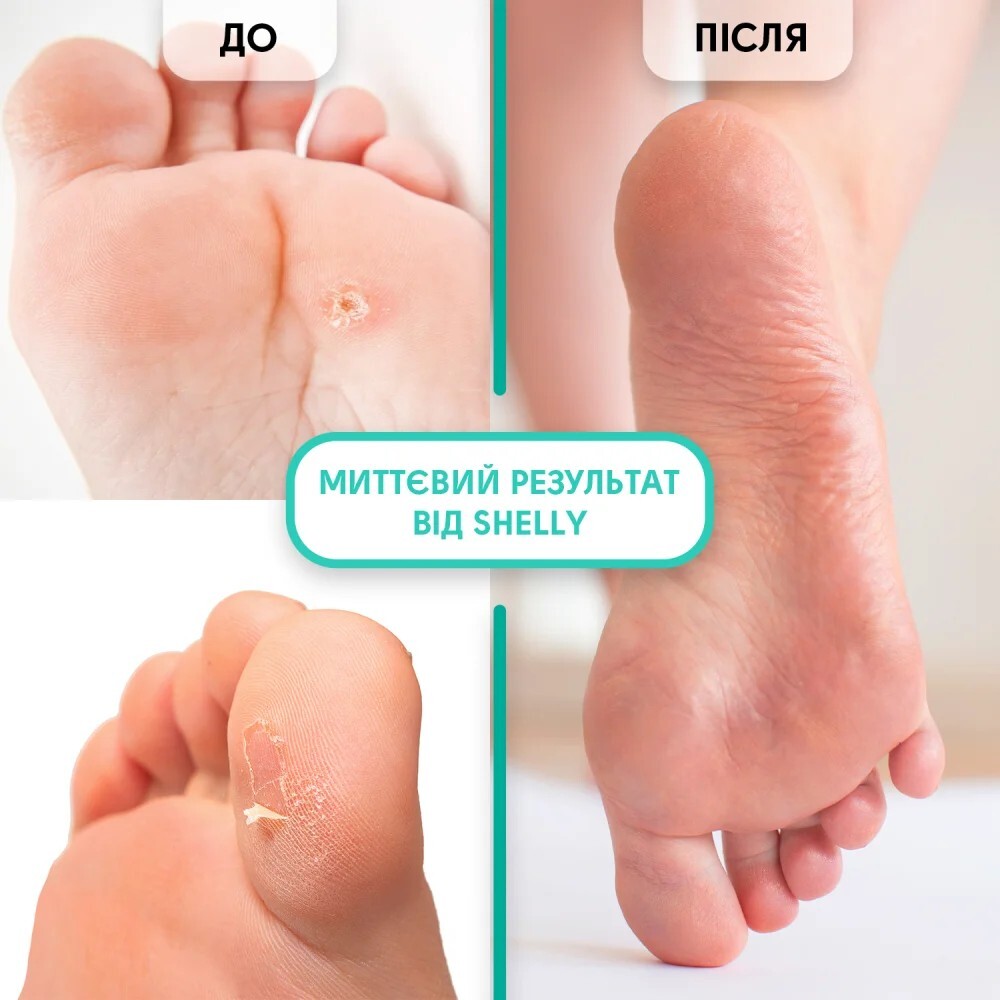 Гель-кератолитик для локального применения Shelly Мягкое лезвие 100 мл фото 