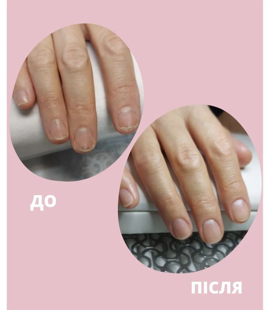 Масло при повреждении ногтевой пластины Shelly Стоп Онихолихис 30 мл фото 