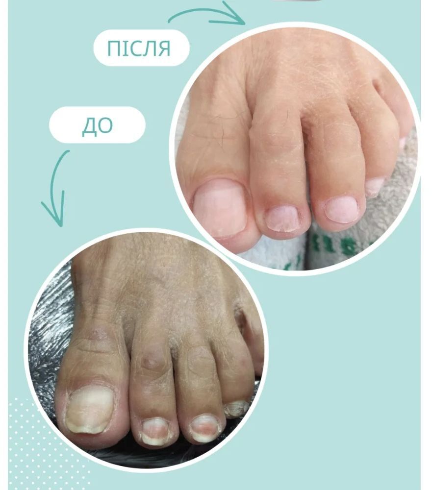 Масло при повреждении ногтевой пластины Shelly Стоп Онихолихис 30 мл фото 