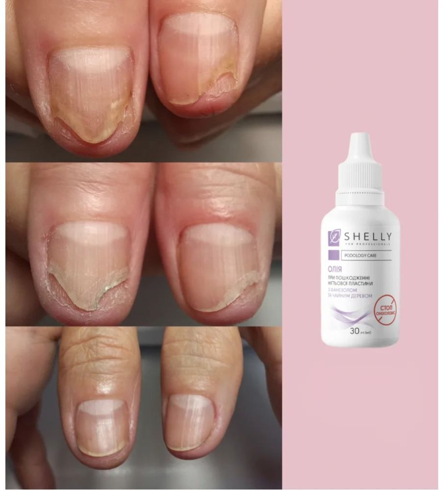 Масло при повреждении ногтевой пластины Shelly Стоп Онихолихис 30 мл фото 